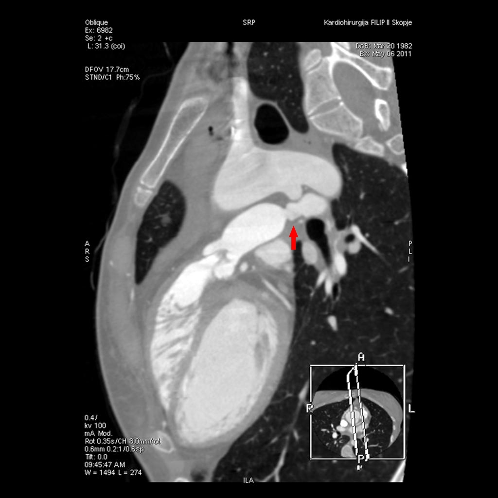 Приказ на тетралогија Фало со МСКТ ангиографија кај адултни пациенти