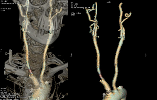 Тромбендаректомија (ТЕА) и пач пластика на пациентка со инсуфициентна десна интерна каротидна артери
