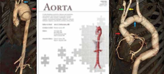 Life treatening surgery for mycotic aneurysm