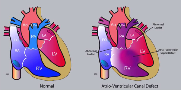 Атриовентрикуларен септален дефект- приказ на случај