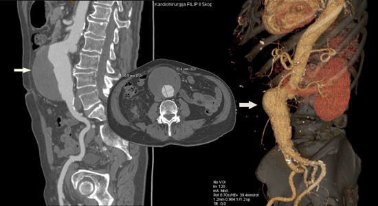 Дијагностика на абдоминална аневризма на аорта со компјутеризирана томографија