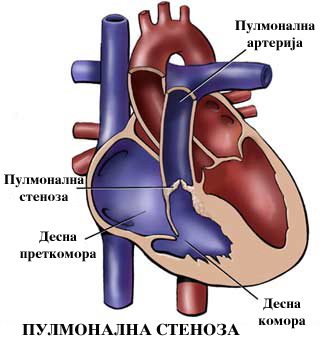 Интервентен третман (балонвалвулопластика) на тешка пулмонална стеноза кај новородено