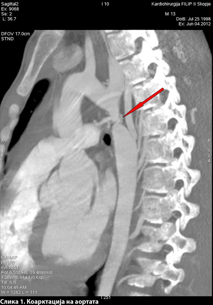 Стентирање на аортна коарктација – современ тренд во лекување на болеста