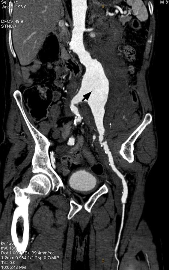 КТ дијагностика на руптурирана аневризма на абдоминална аорта