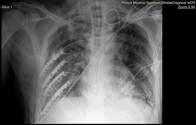 “Journal of Medical Case Reports”: Напредна медицинска нега во ортопедската хирургија на Zan Mitrev Clinic