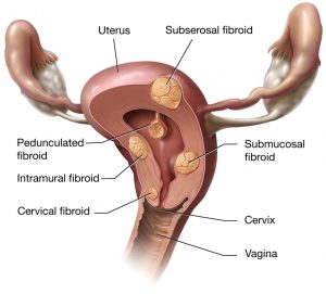 Types-of-fibroids_Zan_Mitrev_Clinic