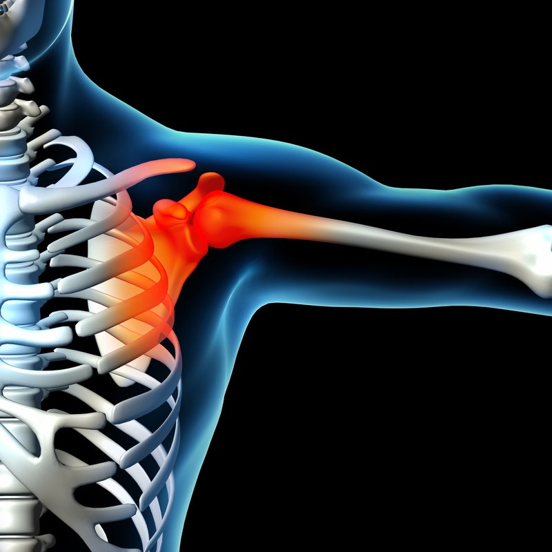 Frozen shoulder syndrome