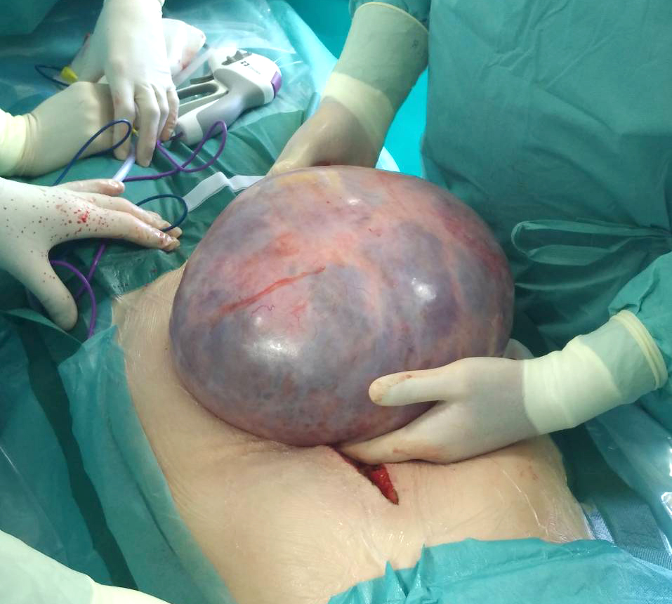 A cystic tumor, weighing 6 kilograms, was removed