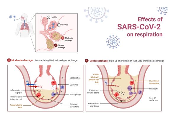 Publication of Petar Ugurov, MD: ”Early initiation of hemofiltration – extracorporeal blood purification in Covid-19 patients″