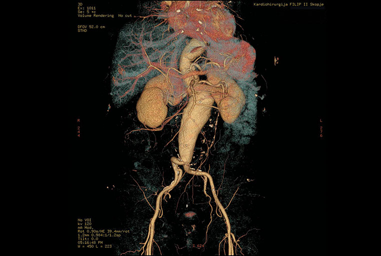 Aneurizma e aortës abdominale