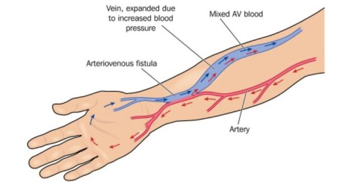 Krijimi i fistulave arteriovenoze tek pacientët me dializë