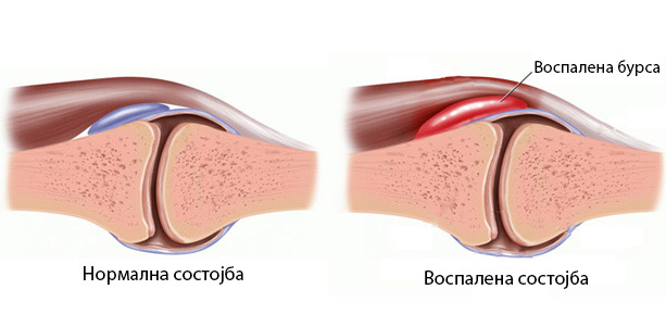 Treatment of broken bones