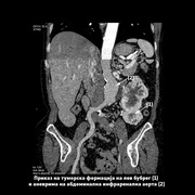 Операција на аневризма на абдоминална аорта и тумор на лев бубрег во еден акт