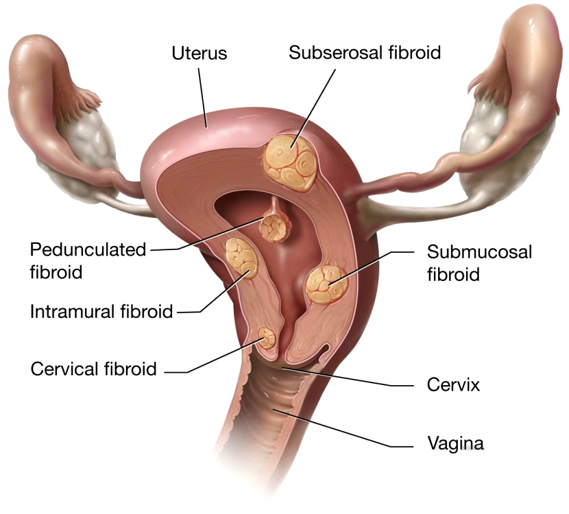 Леомиоми на матка