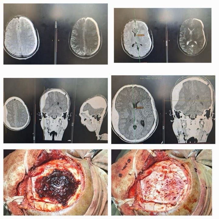 General neurosurgery