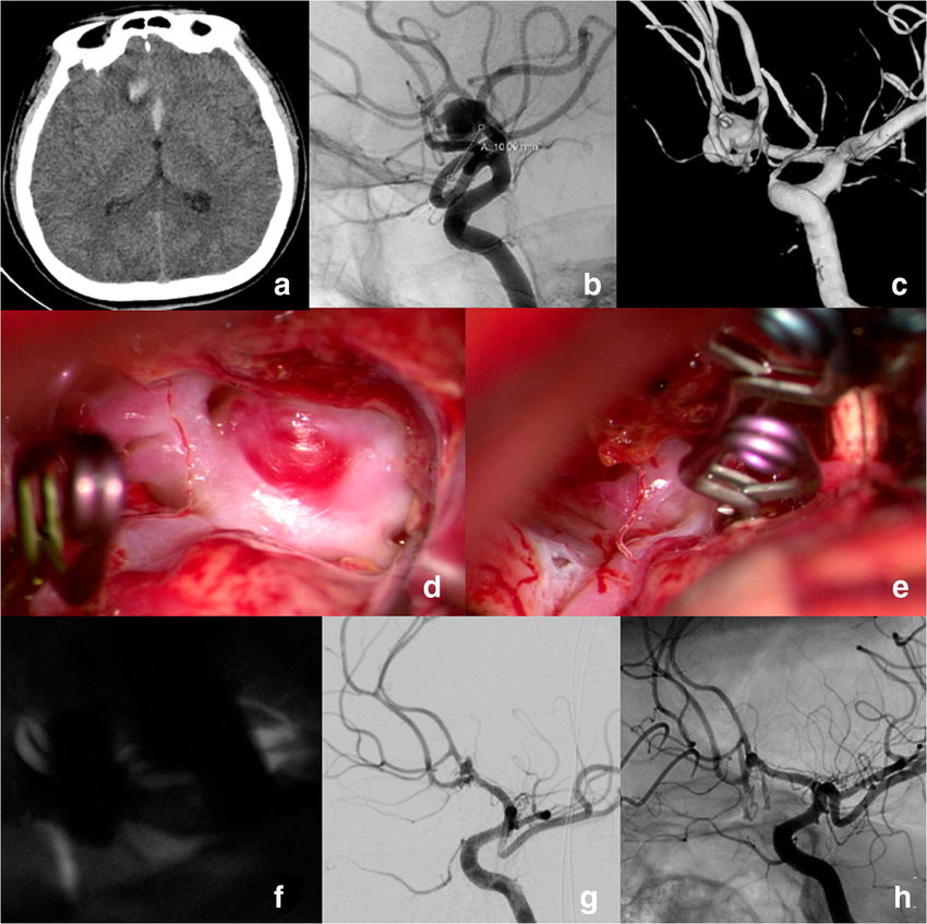 Cerebrovascular procedures