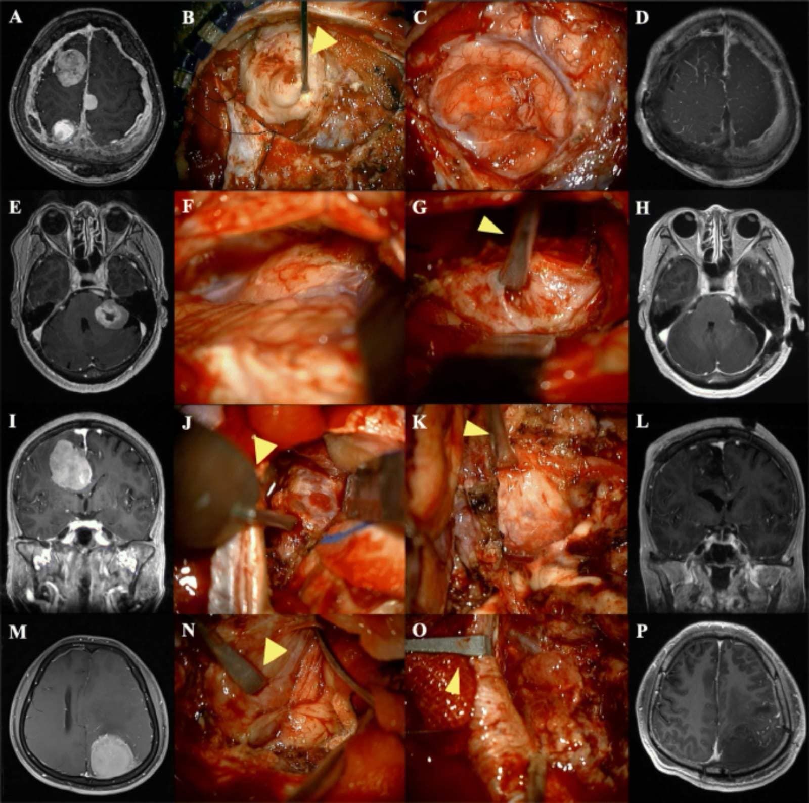 Neuro-oncology (brain tumors)