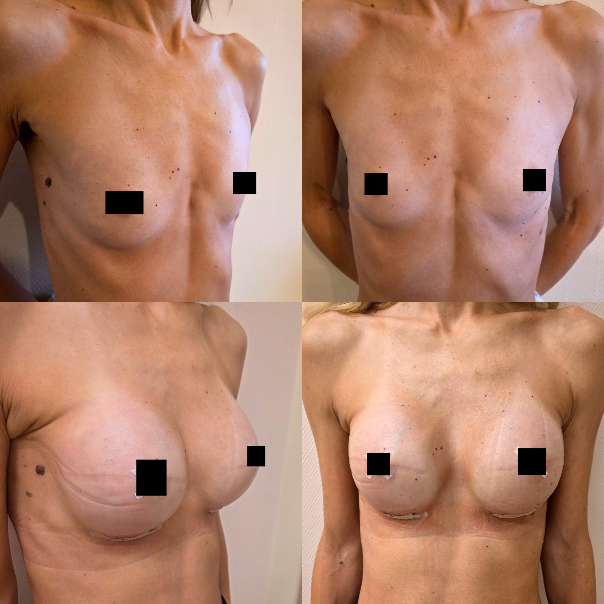 Естеско зголемување на гради со форма што ја следи вашата убавина